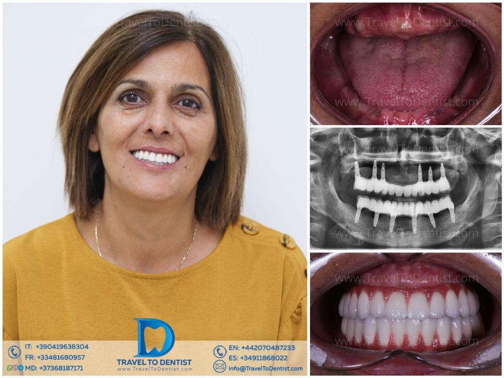 Caso clínico 5 — resultado de tratamiento en Ágata Dental