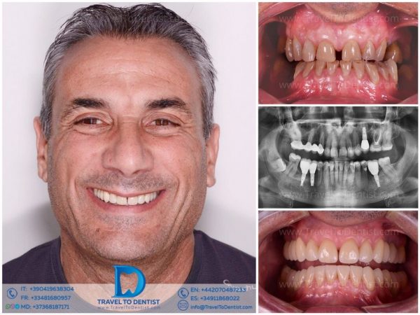 Caso clínico 2 — transformación dental en Ágata Dental