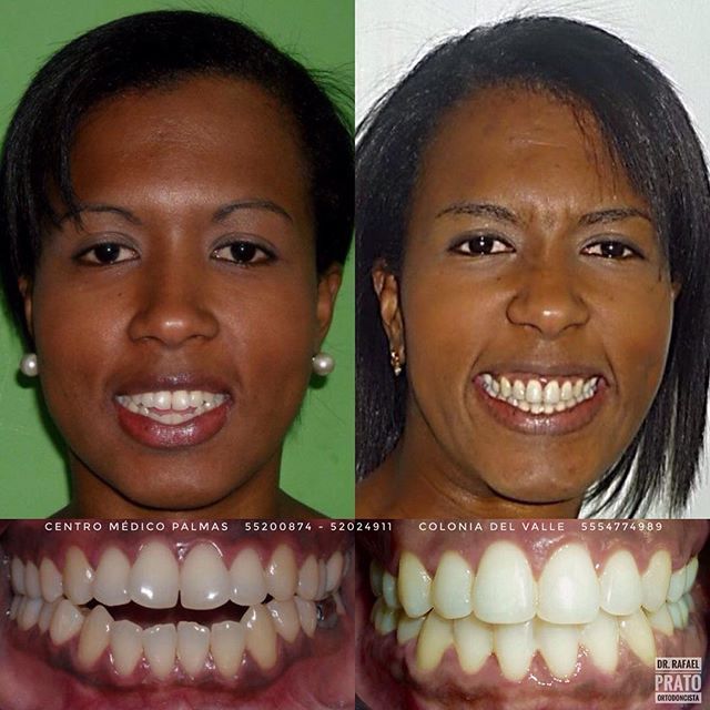 Caso clínico 4 — transformación de sonrisa en Ágata Dental